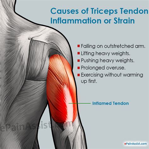 Biceps/Triceps tendon injuries